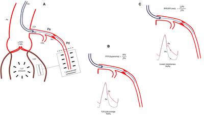 Coronary Assessment and Revascularization Before Transcutaneous Aortic Valve Implantation: An Update on Current Knowledge